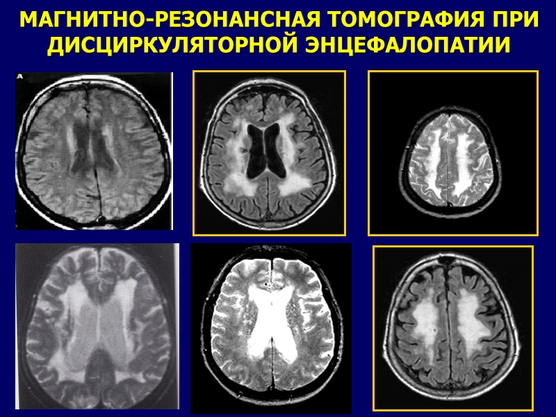 11 МАГНИТНО-РЕЗОНАНСНАЯ ТОМОГРАФИЯ ПРИ ДИСЦИРКУЛЯТОРНОЙ ЭНЦЕФАЛОПАТИИ